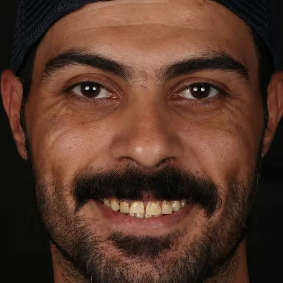 قبل العلاج